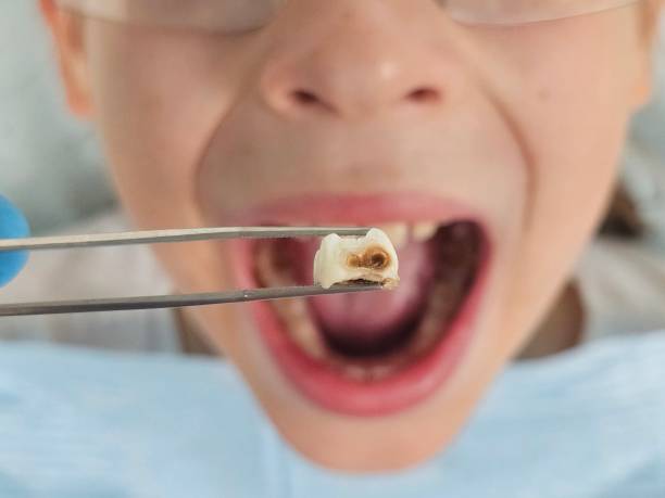 Best Emergency Treatment for Dental Infections or Abscesses in Wrightsboro, NC